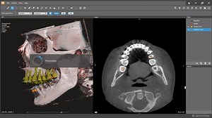 D2P - Segmentation for CMF and Orthognathic Surgery. https://bit.ly/2pTpxhX Request a free trial: https://bit.ly/2LaVUk4 | Surgical Science | Facebook