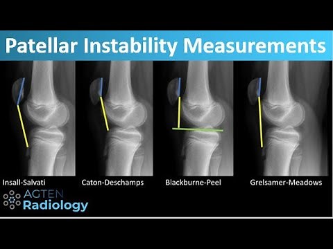 Patellar Instability - What and How to Measure