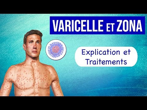 Varicelle et Zona : Explication et traitements