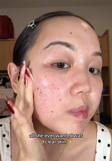 The Struggle for Clear Skin: A Relatable Journey