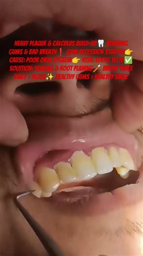 Plaque&Tartar Build-up Causes BleedingGums😷 GumRecessionTreatment Explained#TheDentalGuru #shorts