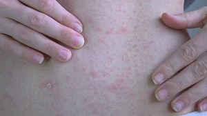 Hands show the affected areas of the skin on the abdominal cavity. On the areas of the rash in red. A centimeter from the navel is a skin rash with a scab. Viral diseases. Close-up | Premium Stock Video Footage