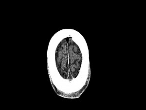 Surgical Training for the Implantation of Neocortical Microelectrode Arrays Using a Formaldehyde-fixed Human Cadaver Model