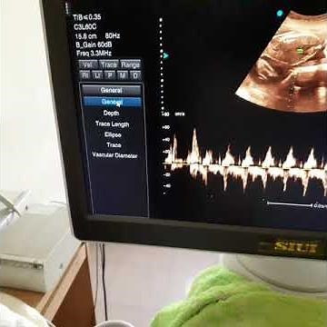 Ultrasonography -How to measures Fetal Heart Rate.