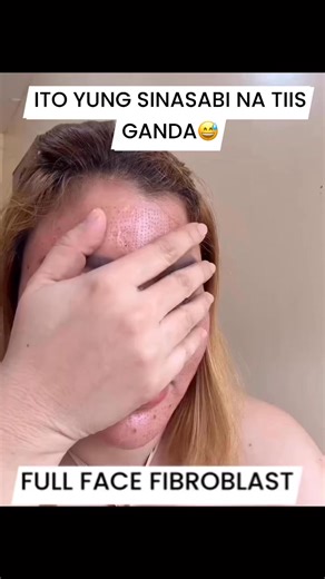 Full Face Fibroblast - is a non-surgical skin tightening treatment that helps rejuvenate the skin. 💞Fine lines & Wrinkle Removal 💞Saggy Skin 💞Acne Scars and melasma Removal 💞 Stretchmark Removal 💞Warts Removal 💞Syringoma Removal 💞 Stimulates Collagen and elastin 💞 Improve Skin Texture 💞 Can last up to 2-3yrs with proper skin maintenance. @highlight | Cannah Overcomer