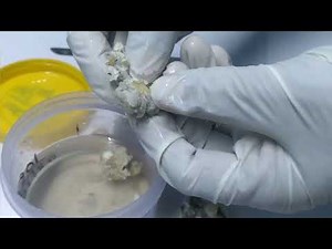 Dermoid Cyst - Dissection in Histopathology Laboratory