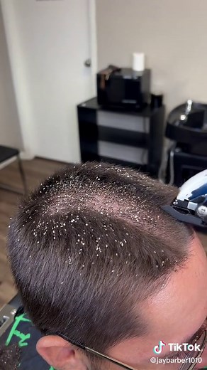 INFESTED IN LIES! CLIENT HAD TO SHAVE HIS HEAD 😳😳😳😳😳 #jaybarber #foryou #ShowUrGrillSkillz #lice #prank #fyp #foryourpage #barbervids #haircut