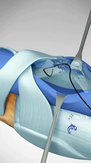 Jersey Finger: Flexor Tendon Injury and Surgery #jerseyfinger #hand #surgery