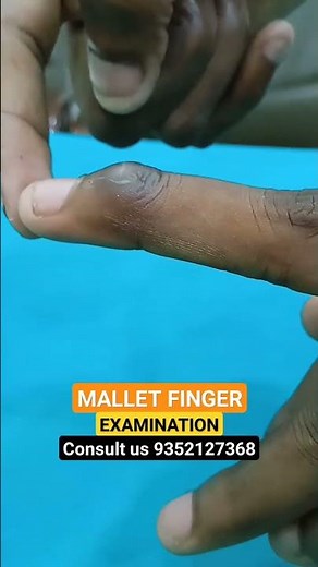 Mallet finger Examination#hand #physiotherapy #pain #advice #finger #movement #thumb #stiffness