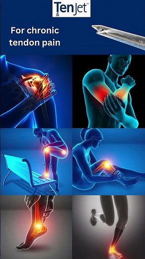 TenJet - a minimally invasive treatment option for chronic tendon pain