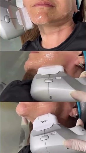 Discover the Power of HIFU Technique! Non-surgical lift • Tightening • Youthful results