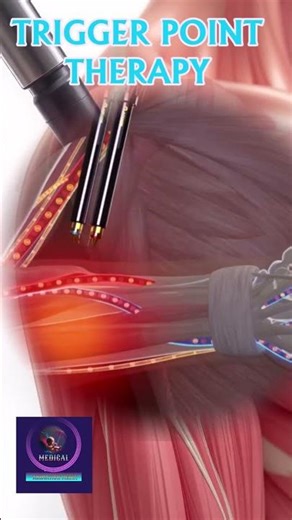 Trigger Point Therapy | Pen Pressure Release Animation |