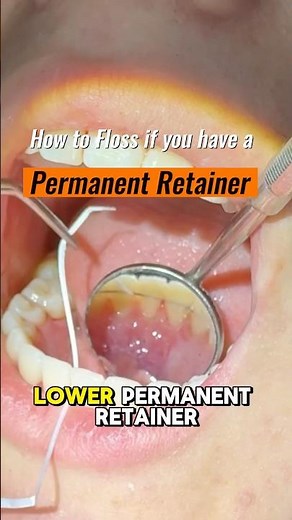 How to Floss with a Permanent Retainer - Toothtime Family Dentistry #dentist #cleanteeth #braceslife