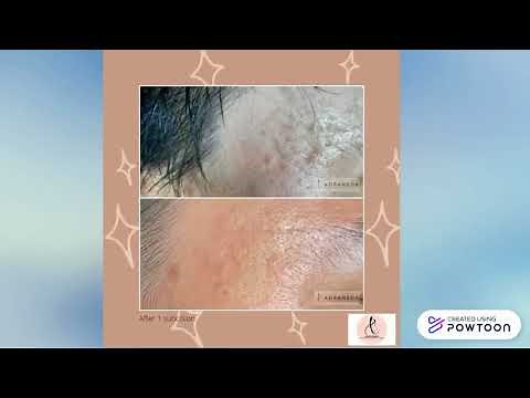 SUBCISION | Acne scar treatments | Rolling scars | Deep boxcar scars