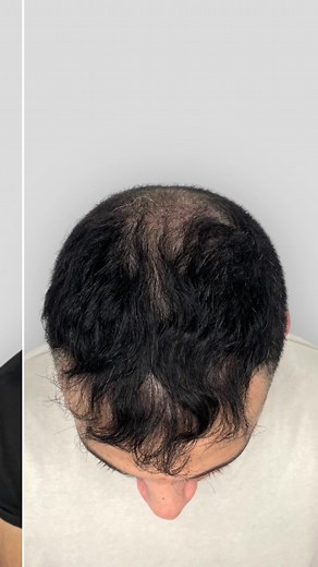 SMP Without Shaving | Scalp Micropigmentation Density Treatment