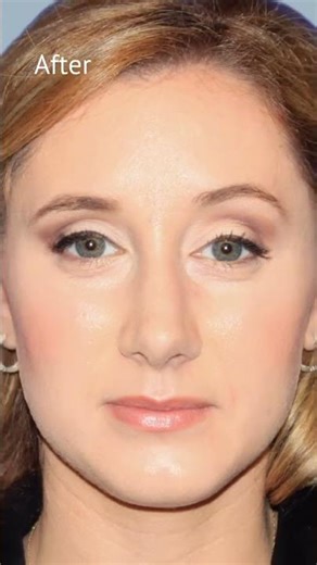 nyc new york city new york Rhinoplasty for Aesthetic Balance and Improved Breathing