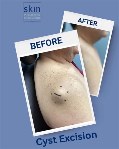 Marie Stoddard Lyndsey, MD on Instagram: "✨ Before & After: Cyst Excision ✨ A cyst is a small pocket under the skin filled with keratin — a protein your body naturally produces. These form when a hair follicle or oil gland gets blocked, trapping the keratin inside. Over time, the cyst can grow, become uncomfortable, or get irritated. This patient had an in-office cyst excision where the entire cyst sac is gently removed to prevent it from returning. The result? A smooth, clean finish and relief 