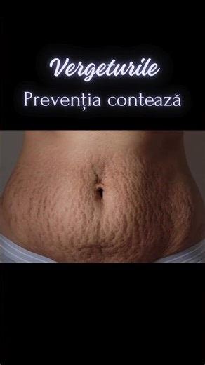🤰 Vergeturile în sarcină: ce nu spune aproape nimeni?
