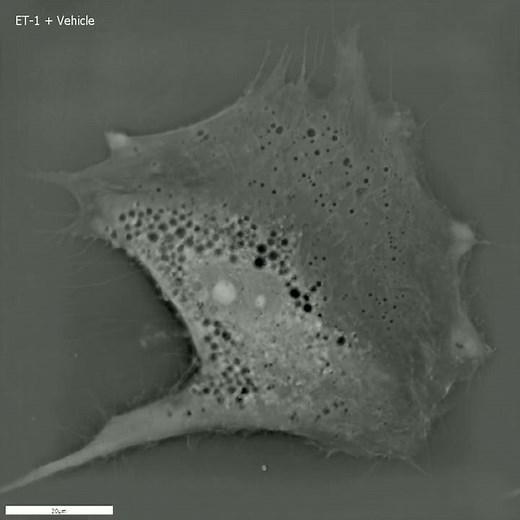 Pulmonary Arterial Hypertension - live cell monitoring with the 3D Cell Explorer