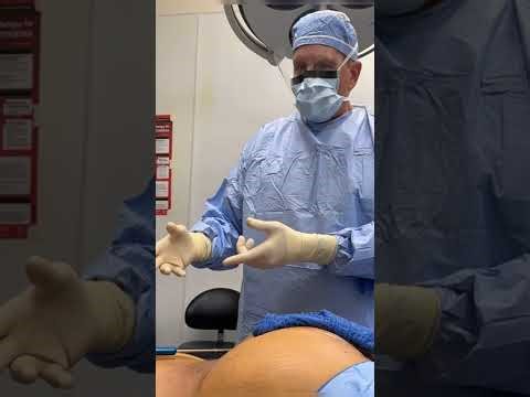 HOW TO PREVENT A BLOWOUT FRACTURE HIGH DEFINITION LIPO BBL BY DR GABRIEL PATINO 9 25 25.(510)5257999