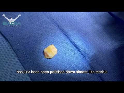 Arthritic CMC joint replaced by BioPRO prosthesis: Solution for base of the thumb arthritis