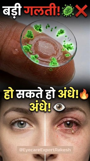 Contact Lens लगाने से पहले ये गलती की तो हो सकते हो अंधे! 👁️❌ | Contact Lens Hygiene