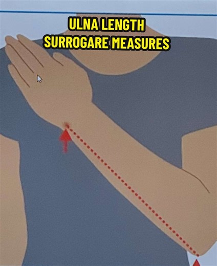 Ulna Length as a Surrogate Measure Ulna length is a measurement of the forearm bone, used to estimate a person's full height when a direct standing measurement is impossible (e.g., in bedridden, elderly, or disabled patients). Purpose: Its primary use is to calculate Body Mass Index (BMI) for nutritional screening. How it Works: The measured length is entered into a simple, population-specific formula to predict full height. Key Feature: It is a quick and practical alternative to knee height, of
