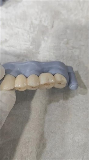 Zirconia posterior bridges are highly durable