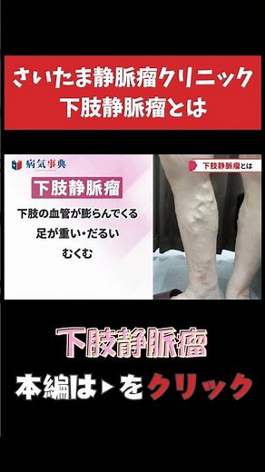【下肢静脈瘤】下肢静脈瘤とは？ #下肢静脈瘤 #足がつる #こむら返り
