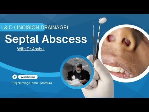Nasal Septal Abscess / Hematoma Incision and Drainage ‪@Entdoctor8‬ नाक में सूजन / मास / फुंसी
