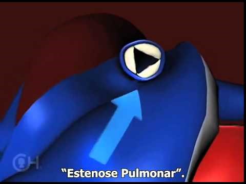 Tetralogia de Fallot