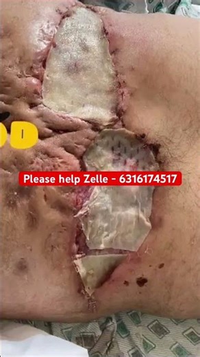 Back abscess surgery