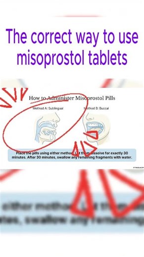 How to Administer Misoprostol Correctly: Sublingual vs. Buccal Methods
