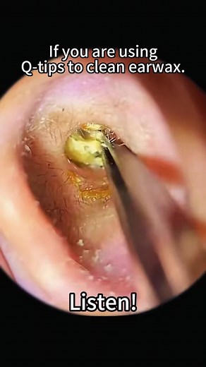 Discover the Benefits of Using an Otoscope for Ear Care