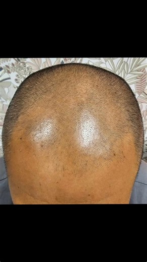 💪 Redonner du style à sa ligne frontale, c’est possible ! La perte de cheveux sur le devant n’est plus une fatalité. La trichopigmentation offre aujourd’hui une solution naturelle et élégante pour redéfinir la ligne frontale et recréer un effet de densité bluffant. Grâce à une technique de micropigmentation du cuir chevelu, de minuscules pigments sont déposés pour imiter l’apparence du cheveu à la racine. Résultat : un rendu discret, harmonieux et ultra-réaliste. 🎯 Idéal pour les hommes qui : 