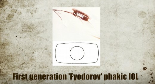 Radial Keratotomy - Eyetube