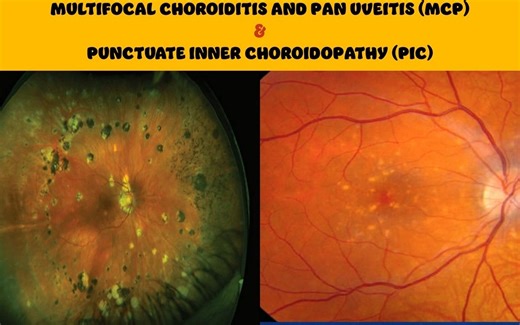 Multifocal choroiditis and Punctate inner choroidopathy - 多灶性脉络膜炎与点状内层脉络膜病变