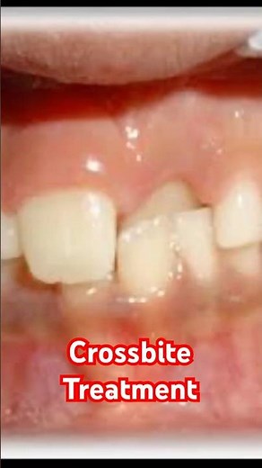 Crossbite treatment : Tongue blade therapy