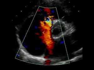 Atrial Septal Defect Pre and Post Amplatzer Device Closure