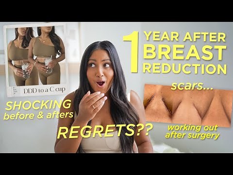 WATCH THIS Before You Consider A Breast Reduction | Scars, REGRETS & Before and Afters 1 Year Later