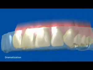 How Crest 3D Whitestrips Work
