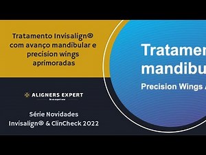 Tratamento Invisalign® com avanço mandibular e precision wings aprimoradas