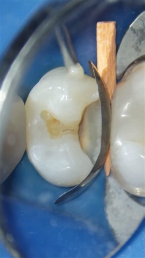Class II Composite Restoration Step by Step #shorts #dentist