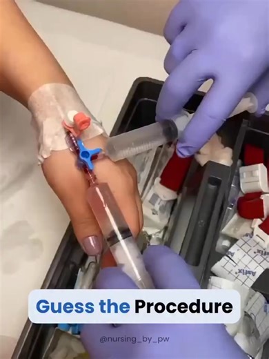 #Adenosine #SVT #SupraventricularTachycardia #CardiacArrhythmia #EmergencyMedicine #ACLS #Cardiology #ECG #HeartRhythm #RapidInfusion #ThreeWayStopcock #IVAccess #ClinicalSkills #CriticalCare #LifeSavingSkills #MedEd #MedicalStudent #DoctorLife #MedTok #MedicalEducation #HealthTok #ForYou #ForYouPage #FYP #ViralMedical #EmergencyCare #ERLife #GlobalHealth #LearnOnTikTokThis video depicting rapid adenosine infusion via a 3-way stopcock into an IV line, with arm elevation, to treat supraventricula