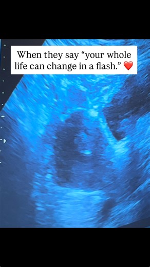 With an embryo transfer, your whole life really can change in a “flash.” So what is this quick flash of light that we see during the embryo transfer? Is it the embryo? First, let’s talk about what happens during the embryo transfer procedure. Typically, a catheter is inserted through the vagina and cervix into the uterus using an abdominal ultrasound as a guide. You can sometimes see this catheter moving through the cervix into the uterus on the ultrasound screen (it appears as a white line). So