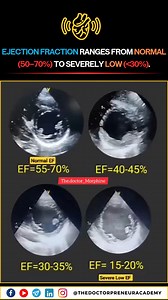 Ejection fraction ranges from normal (💖 50–70%) to severely low (❗️