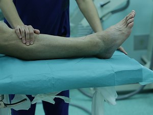 Treatment of Ankle Osteoarthritis with Total Ankle Replacement Through a Lateral Transfibular Approach
