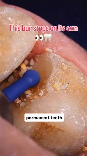 DrSimarGulati on Instagram: "PolyBur P1 is a self-limiting polymer bur designed for selective caries removal. It efficiently removes soft, infected dentin and becomes ineffective on sound dentin — preventing over-preparation and preserving tooth strength. ✔ Conservative dentistry ✔ Pulp-friendly ✔ Tooth-saving technology #trending #dentistryworld #knowledge #dentist #dentaltips"