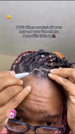 Seborrheic flare up #seborrheicdermatitis #satisfyingvideo #FlakeFree #flareup #hairtok2023 #2025reels #watchtilltheend #seborrea #NaturalHealing #blackamerican #florida #haircare #sad #saudiarabia #satisfying | Rosemary Chigaemezu Alokam