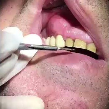 ●●● Popping a Huge Dental Abscess 😳